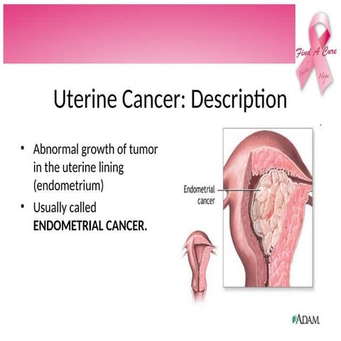 Cancer And Malignancies in Female Genitalia