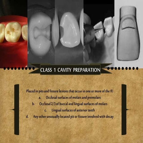 Cavity preparation class 1