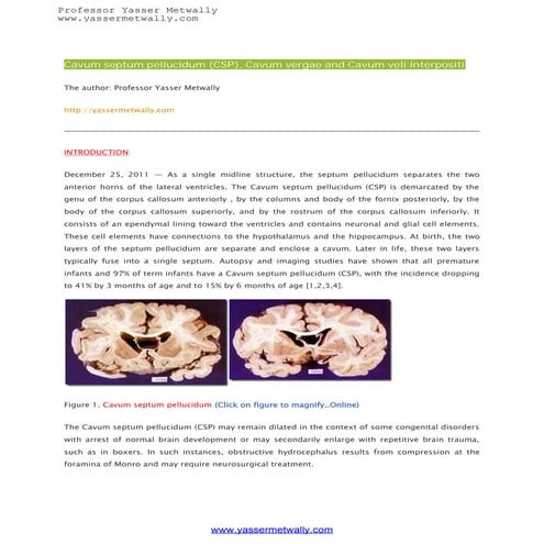 Cavum septum pellucidum (CSP), Cavum vergae and Cavum veli interpositi