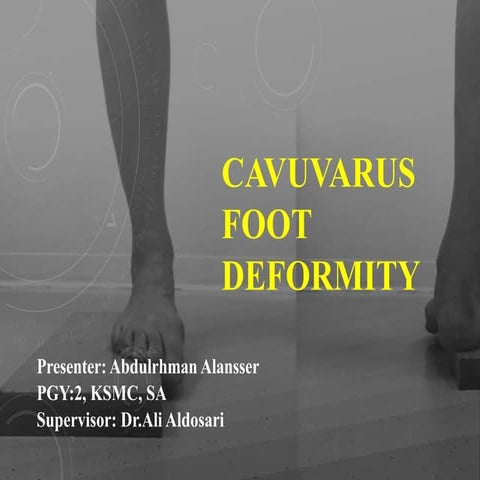 Cavuvarus foot deformity by abdulrhman alnasser