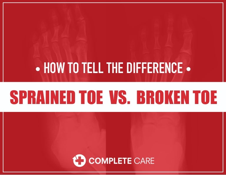Sprained Toe Vs Broken Toe How To Tell The Difference Sprained Toe Vs Broken Toe How To Tell The Difference
