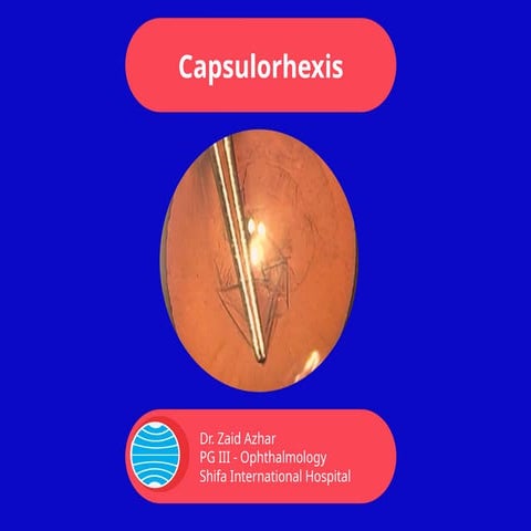 Contiunous Curvilinear Capsulorhexis  .pptx
