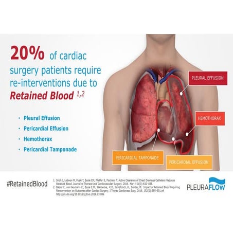8. 20% of Cardiac Surgery Patients Require Re-Intervention Due To ...