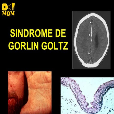 Sindrome Gorlin Goltz | PDF
