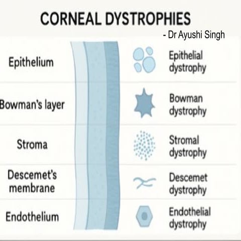 corneal dystrophies a comparative table of all 4 types | PPTX