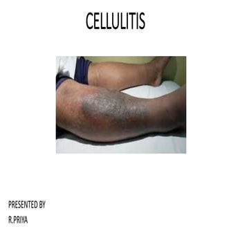Cellulitis