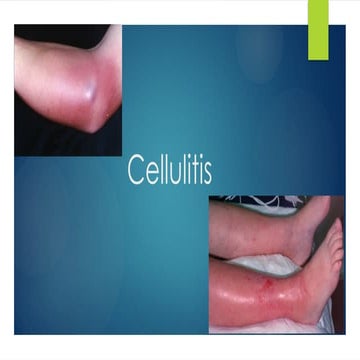 Cellulitis | PPTX