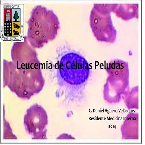 Leucemia Celulas Peludas. Tricoleucemia