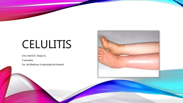 infección por flebitis celulitis infección por flebitis celulitis