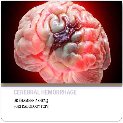 CEREBRAL HEMORRHAGE-1.pdf