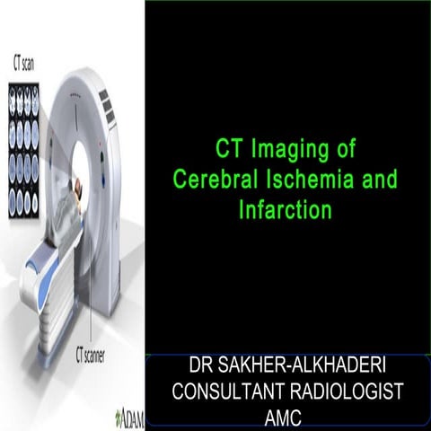 CT Imaging of Cerebral Ischemia and Infarction 