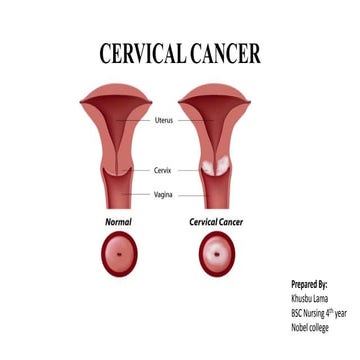 Cervical cancer 
