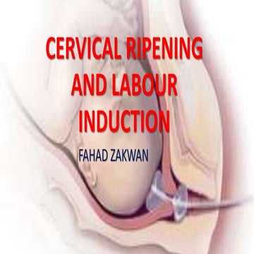 Cervical ripening | PPTX