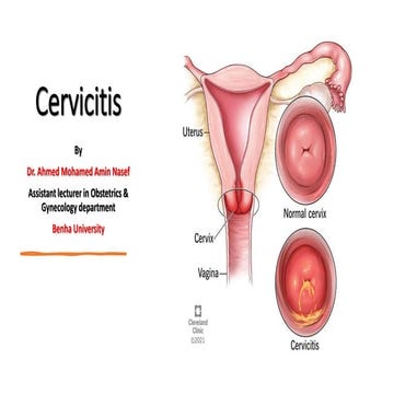 Cervicitis.pptx