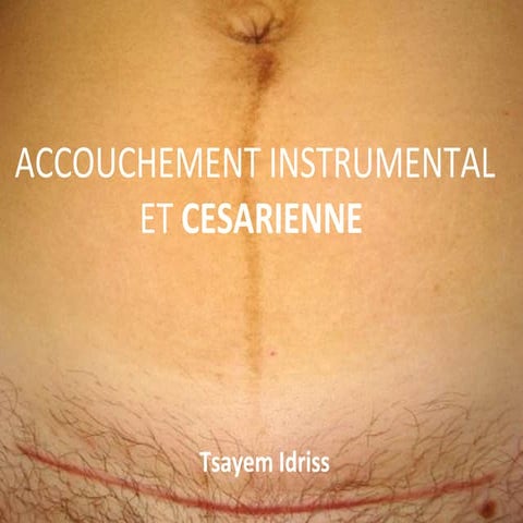 Cesarienne | PPT