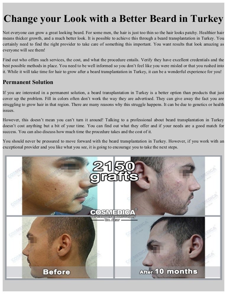 Change Your Look With A Better Beard In Turkey