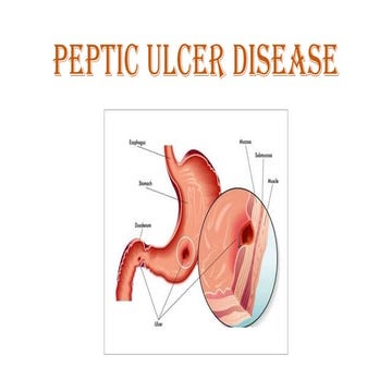 Peptic ulcer disease | PPTX