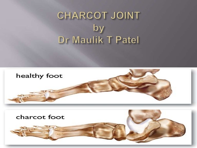 Charcot joint / Neuropathic Joint
