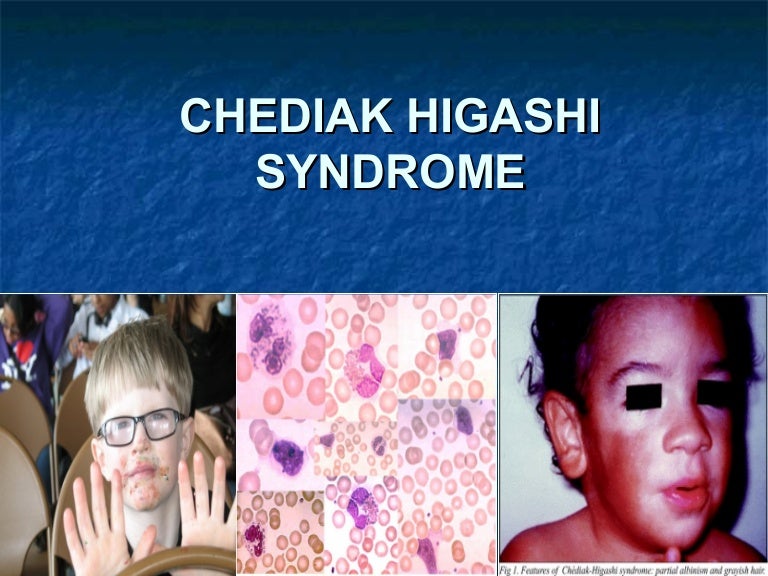 Chediak Higashi Syndrome Phenylketonuria Dentinogenesis Imperfecta
