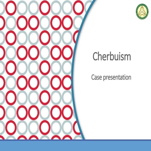 Cherubism "case presentation "