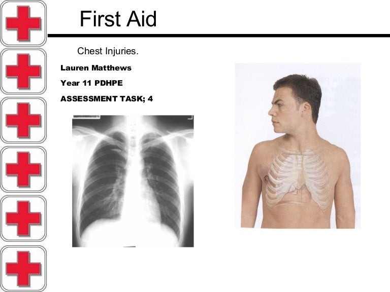 Chest Injuries