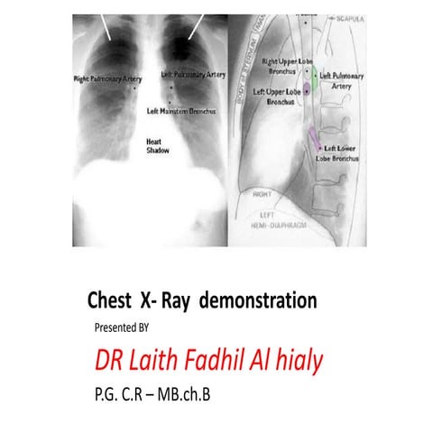 Chest   x - ray 