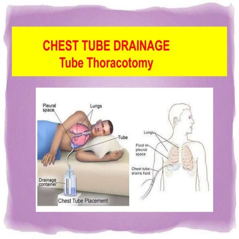 Chest tube insertion ppt (surgery) | PPTX