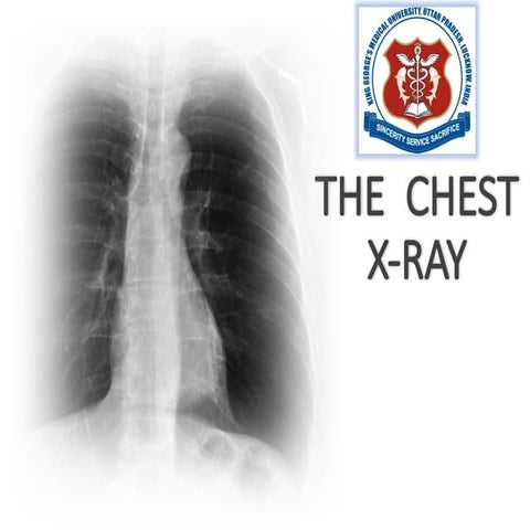 Chest Xray Radiograph Brief explain .pptx