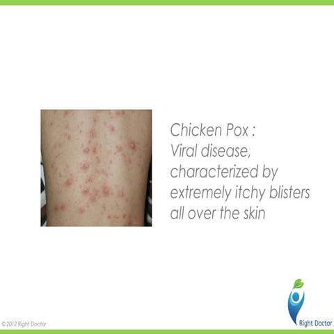 Chickenpox