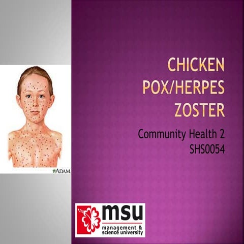 Chicken pox