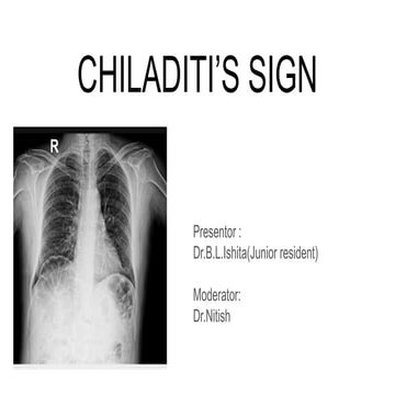 Understanding Chiladiti’s Sign: Radiological Insights and Clinical ...