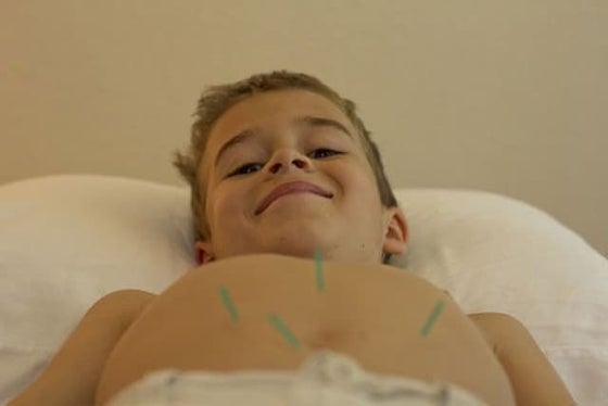 Needles use in Acupuncture | PDF