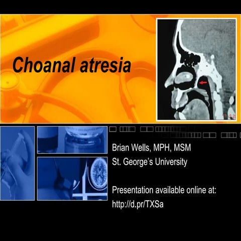 Choanal atresia