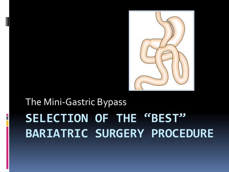 Mini-Gastric Bypass: Best Surgery;