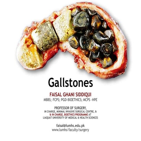 Cholelithiasis - By Sir Faisal Ghani