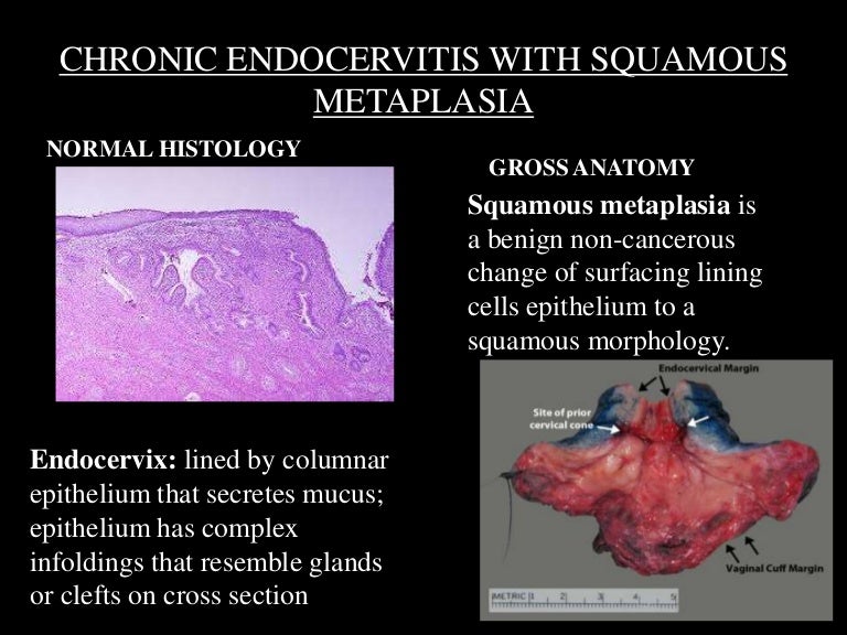 Chronic endocervitis with squamous metaplasia Chronic endocervitis with squamous metaplasia