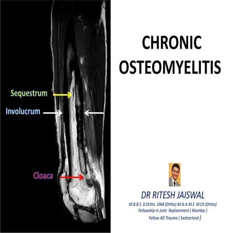 CHRONIC  OSTEOMYELITIS