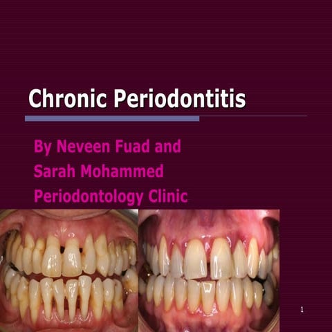 Chronic periodontitis