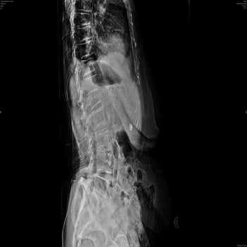 L1 Vertebra Fraktürü