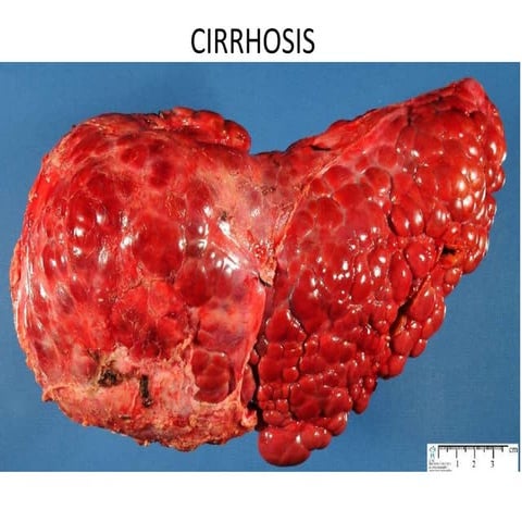 Cirrhosis