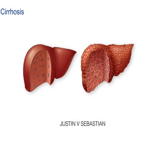Cirrhosis.pdf
