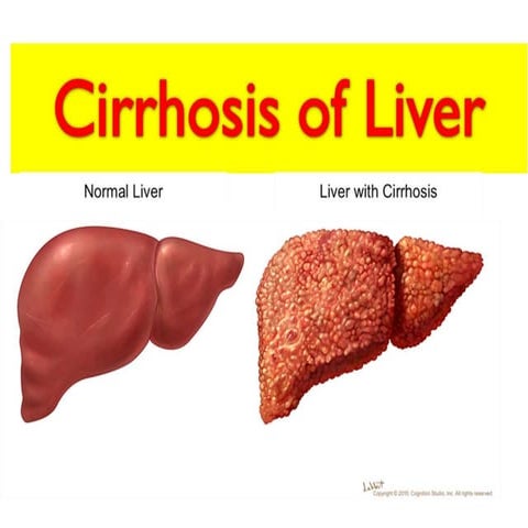 Cirrhosis of liver