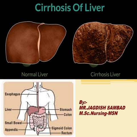 Cirrhosis of liver