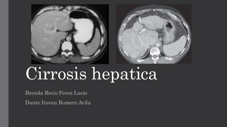 Cirrosis Hepatica