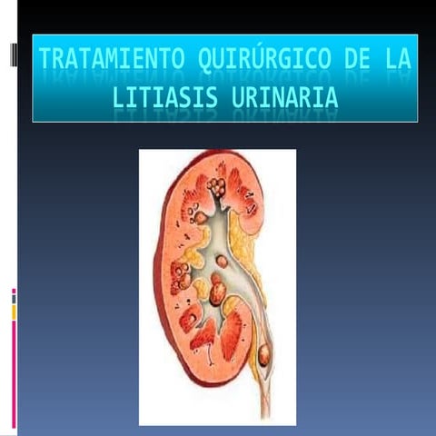 Cirugía litiasis   esteban