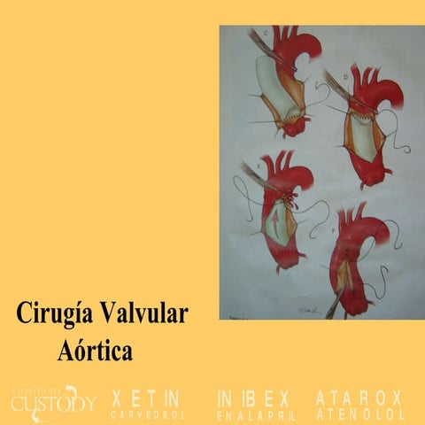 Cirugia Valvulopatia Aortica
