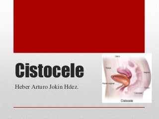‘CISTOCELE’ on SlideShare
