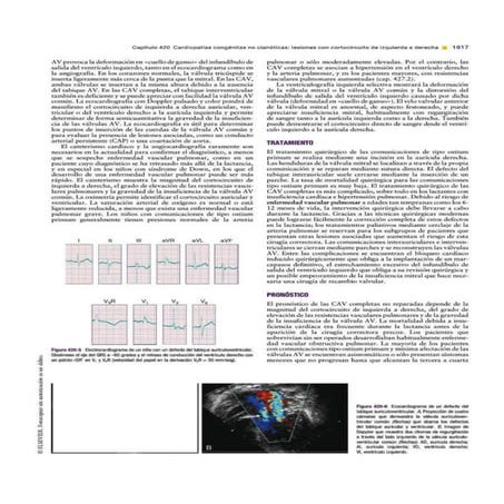 Comunicación Interventricular | Tratado de Pediatria de Nelson 19 Ed.