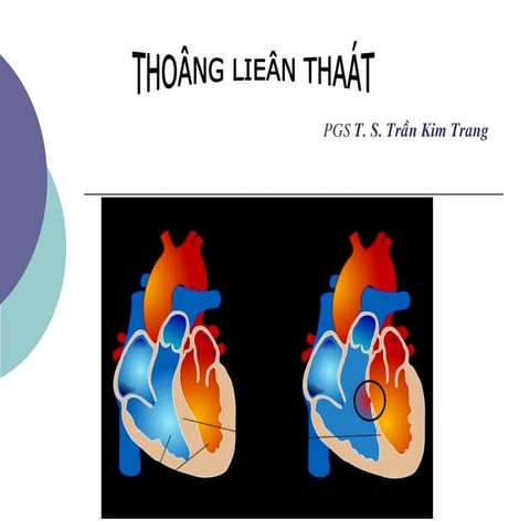 Comprehensive Overview of Ventricular Septal Defect: Anatomy, Diagnosis ...