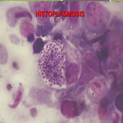 Clase 13 histoplasmosis 2015